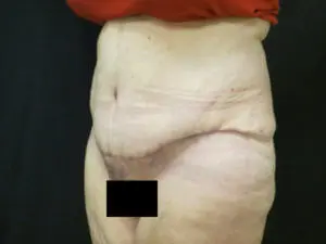 Pickart Plastic Surgery Before and After Pictures