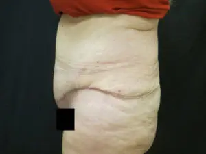 Pickart Plastic Surgery Before and After Pictures