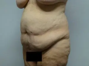 Pickart Plastic Surgery Before and After Pictures