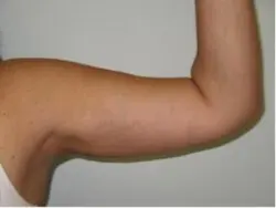 Pickart Plastic Surgery Before and After Pictures