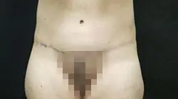 Pickart Plastic Surgery Before and After Pictures