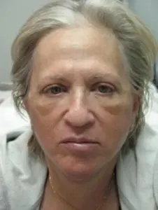 Pickart Plastic Surgery Before and After Pictures