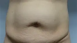 Pickart Plastic Surgery Before and After Pictures