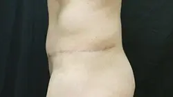 Pickart Plastic Surgery Before and After Pictures