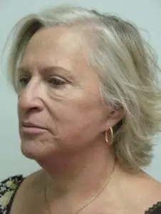 Pickart Plastic Surgery Before and After Pictures