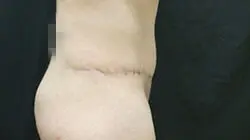 Pickart Plastic Surgery Before and After Pictures