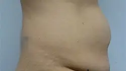 Pickart Plastic Surgery Before and After Pictures