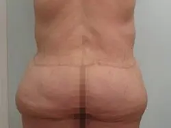 Pickart Plastic Surgery Before and After Pictures