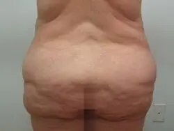 Pickart Plastic Surgery Before and After Pictures