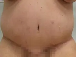 Pickart Plastic Surgery Before and After Pictures