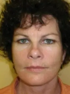 Pickart Plastic Surgery Before and After Pictures