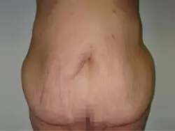 Pickart Plastic Surgery Before and After Pictures