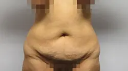 Pickart Plastic Surgery Before and After Pictures