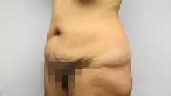 Pickart Plastic Surgery Before and After Pictures