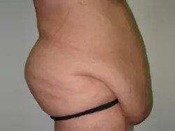 Pickart Plastic Surgery Before and After Pictures