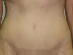 Pickart Plastic Surgery Before and After Pictures