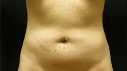 Pickart Plastic Surgery Before and After Pictures