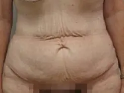 Pickart Plastic Surgery Before and After Pictures