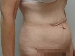 Pickart Plastic Surgery Before and After Pictures