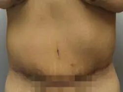 Pickart Plastic Surgery Before and After Pictures