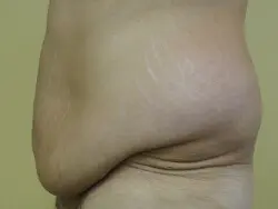 Pickart Plastic Surgery Before and After Pictures