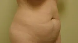 Pickart Plastic Surgery Before and After Pictures