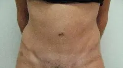 Pickart Plastic Surgery Before and After Pictures