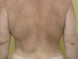 Pickart Plastic Surgery Before and After Pictures