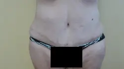 Pickart Plastic Surgery Before and After Pictures