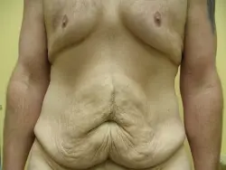 Pickart Plastic Surgery Before and After Pictures