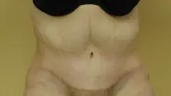 Pickart Plastic Surgery Before and After Pictures