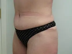 Pickart Plastic Surgery Before and After Pictures