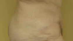 Pickart Plastic Surgery Before and After Pictures