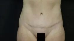 Pickart Plastic Surgery Before and After Pictures