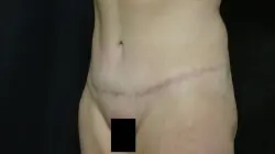 Pickart Plastic Surgery Before and After Pictures