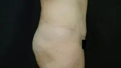 Pickart Plastic Surgery Before and After Pictures