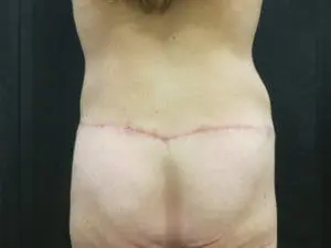 Pickart Plastic Surgery Before and After Pictures