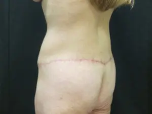 Pickart Plastic Surgery Before and After Pictures