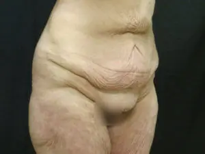 Pickart Plastic Surgery Before and After Pictures