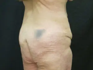 Pickart Plastic Surgery Before and After Pictures