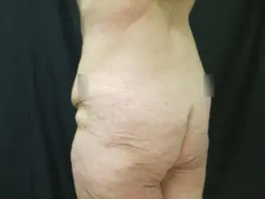 Pickart Plastic Surgery Before and After Pictures