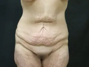 Pickart Plastic Surgery Before and After Pictures