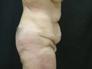 Pickart Plastic Surgery Before and After Pictures