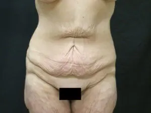 Pickart Plastic Surgery Before and After Pictures