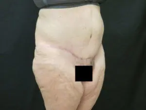 Pickart Plastic Surgery Before and After Pictures