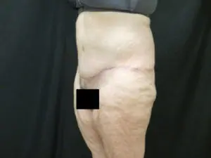 Pickart Plastic Surgery Before and After Pictures