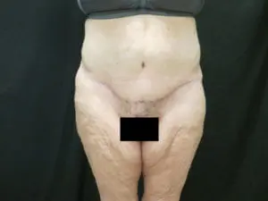 Pickart Plastic Surgery Before and After Pictures