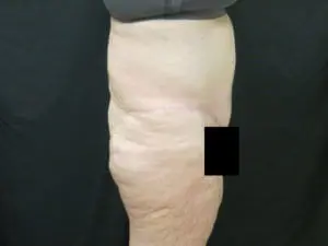 Pickart Plastic Surgery Before and After Pictures