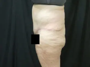 Pickart Plastic Surgery Before and After Pictures