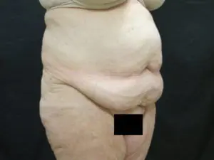 Pickart Plastic Surgery Before and After Pictures